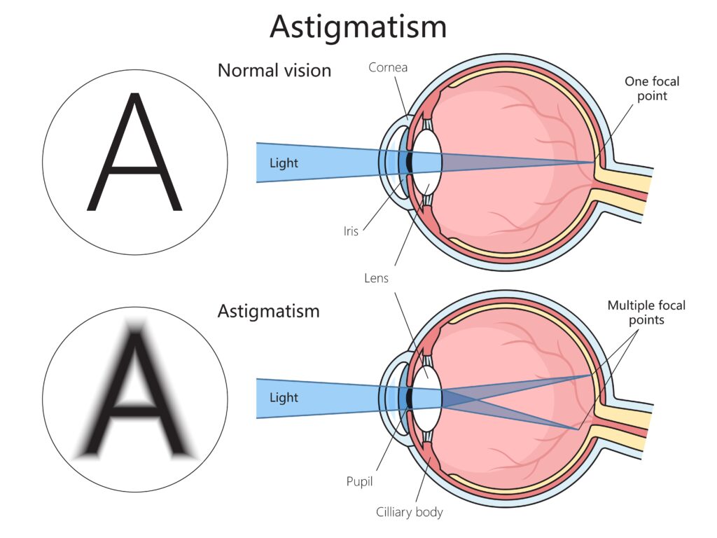 Astigmatism image