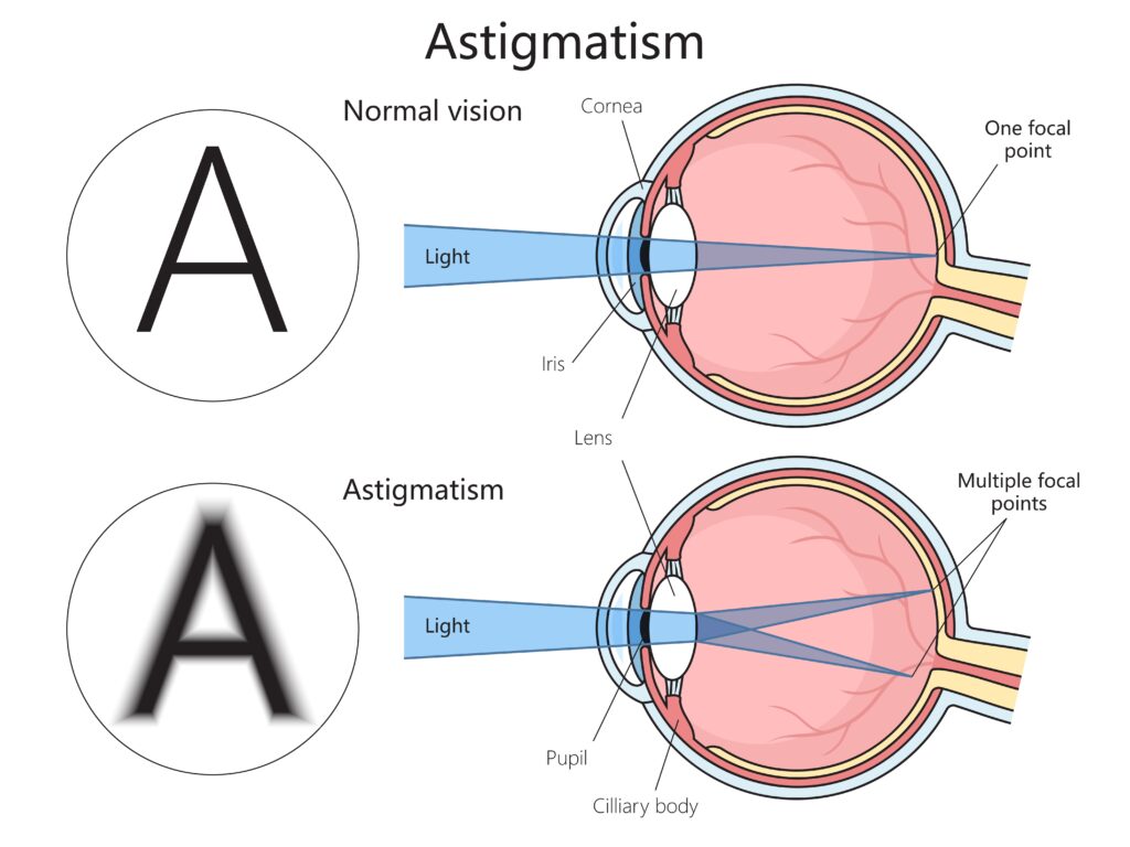 Everything You Need To Know About IOLs University Eye Specialists Everything You Need To Know About IOLs University Eye Specialists